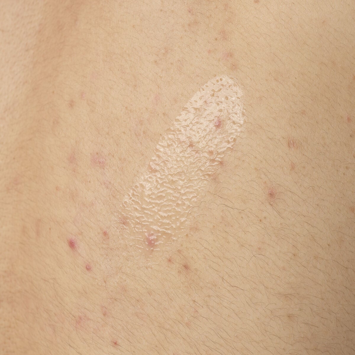 salicylic-acid-0-5-body-serum-w4 ORD-salicylic-acid-05-body-240ml-application.jpg