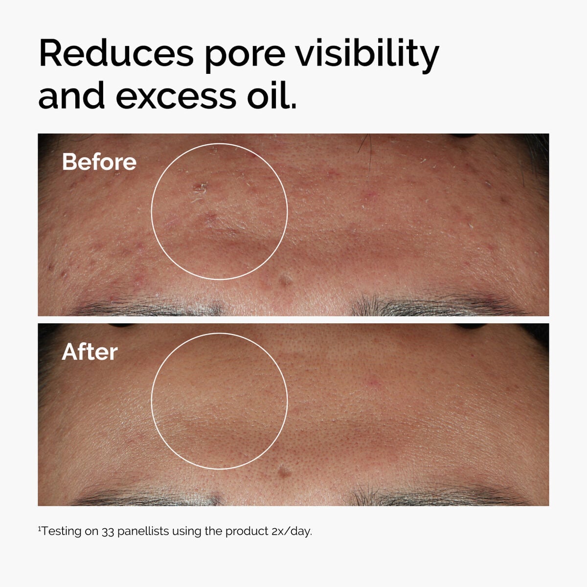 niacinamide-10-zinc-1-b9 ord-niacinamide-zinc-blemish-serum-before-after-pores.jpg