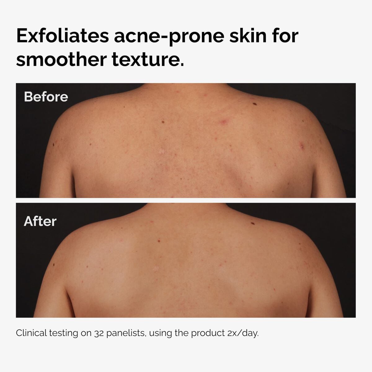 salicylic-acid-0-5-body-serum-w4 ord-salicylic-acid-body-serum-before-after-graphic-NA.jpg