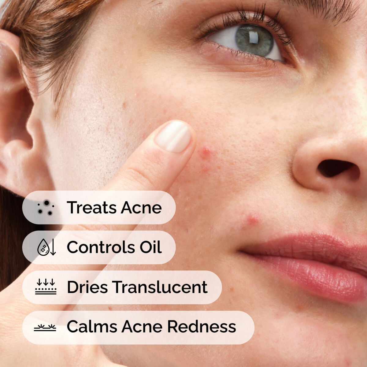 sulfur-10-powder-to-cream-concentrate-d0 ord-sulfur-10pct-powder-to-cream-concentrate-model-application-with-benefits-acne.jpg